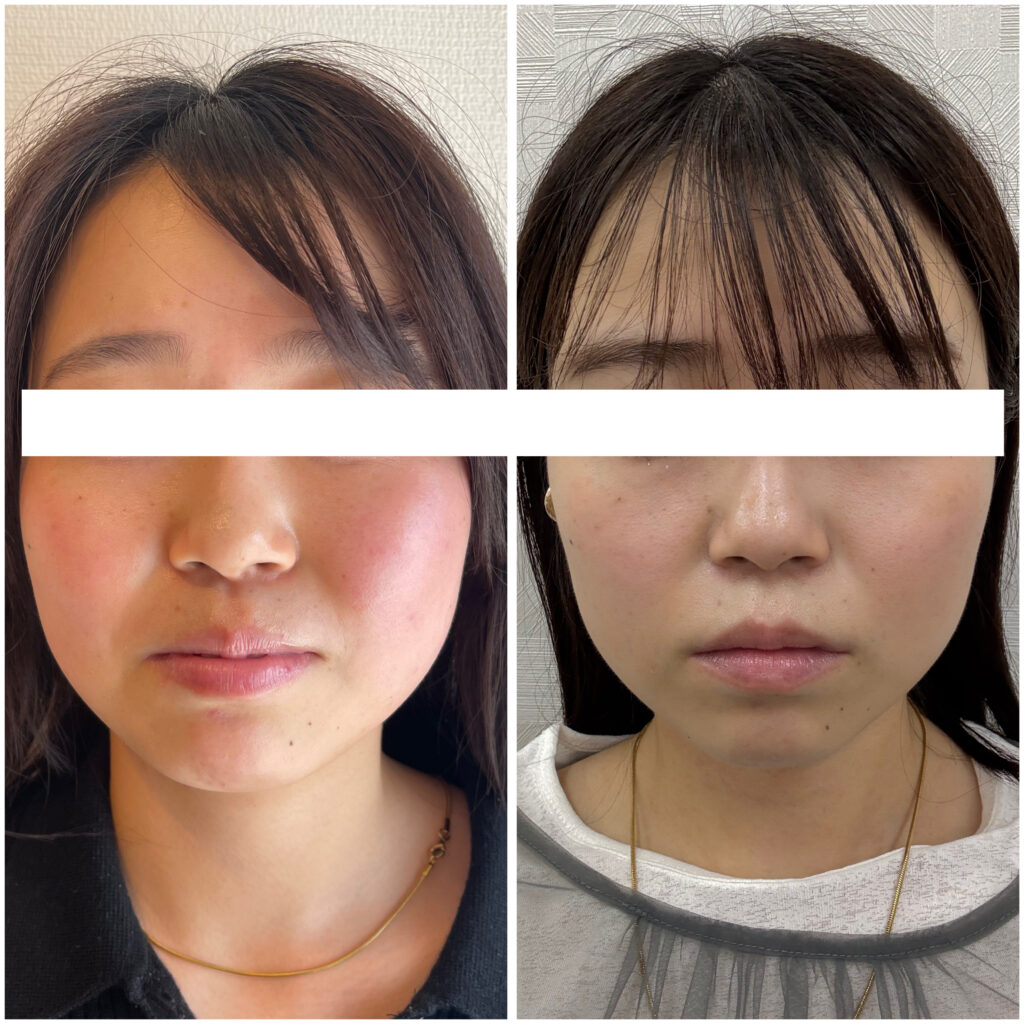 美容鍼の施術直後のビフォーアフター