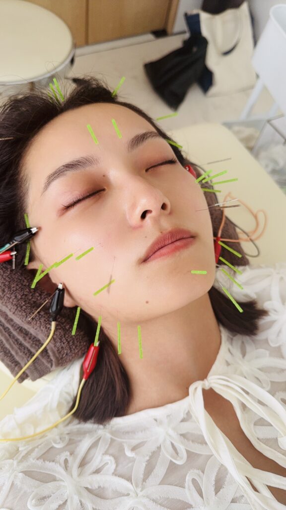 電気的美容鍼を受ける美女