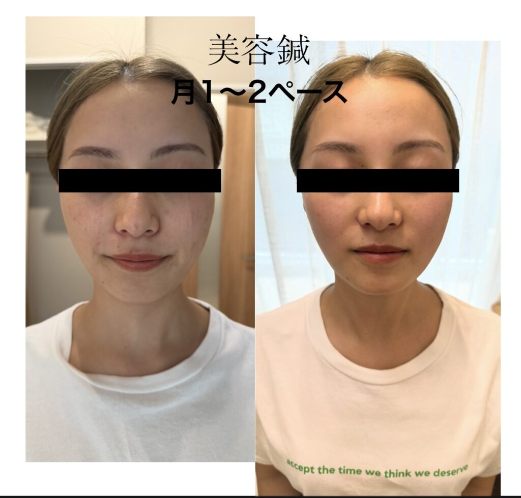 美容鍼の施術のビフォーアフター