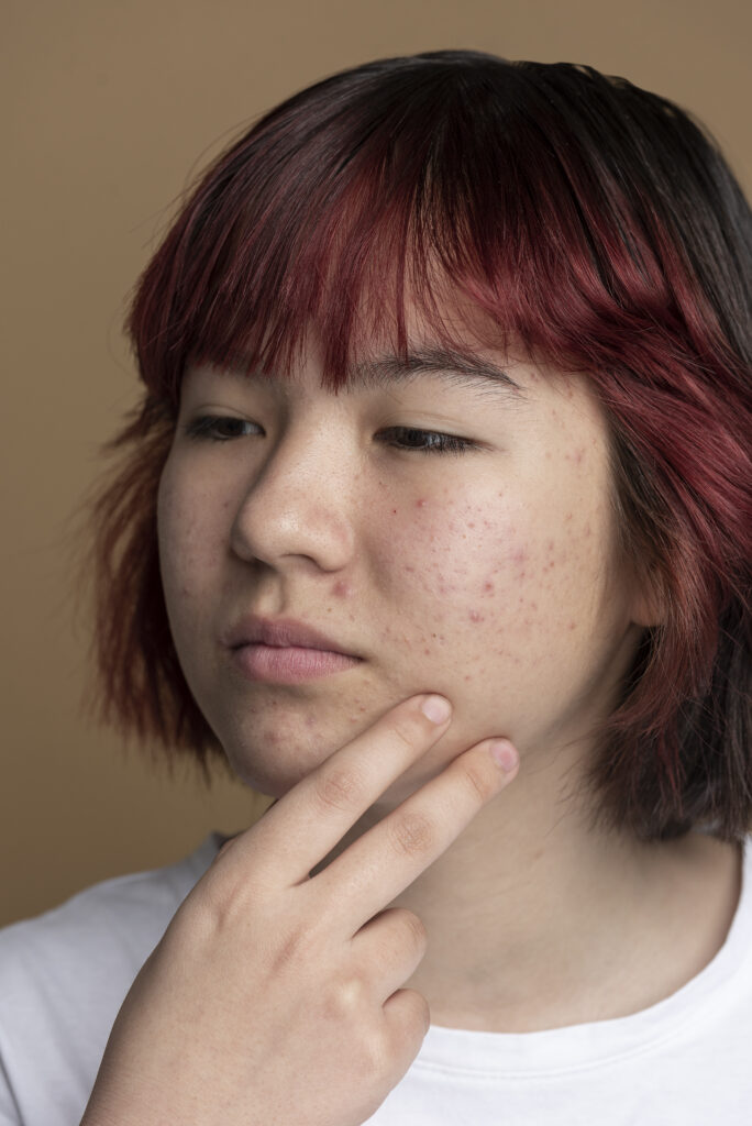 ニキビを無意識で触ってしまう女性